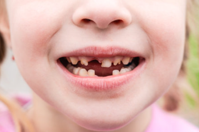 Afla cand apar dintii de lapte, cand cad, cum ii îngrijim si de ce sunt esentiali pentru sanatatea dentara a copilului tau.